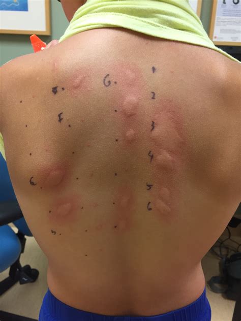 scratch test allergy|allergy scratch test on back.